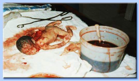 aborto mediante nascita parziale