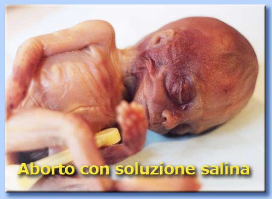 aborto soluzione salina