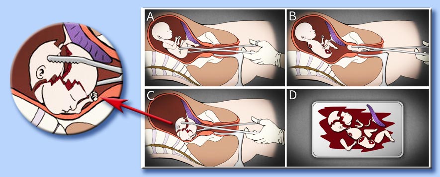 aborto per dilatazione ed evacuazione