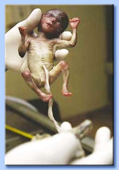 feto umano ucciso