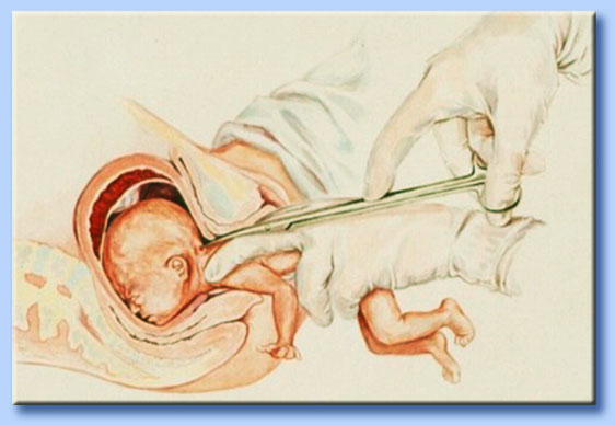 partial birth abortion