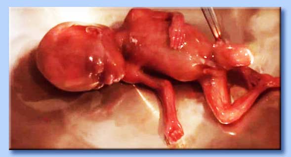 bambino ucciso con l'aborto procurato
