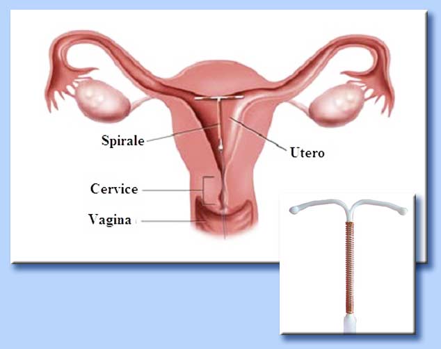 spirale intrauterina